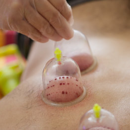 Woman holding a needle in an acupuncture therapy