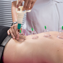 a medical cupping therapy session