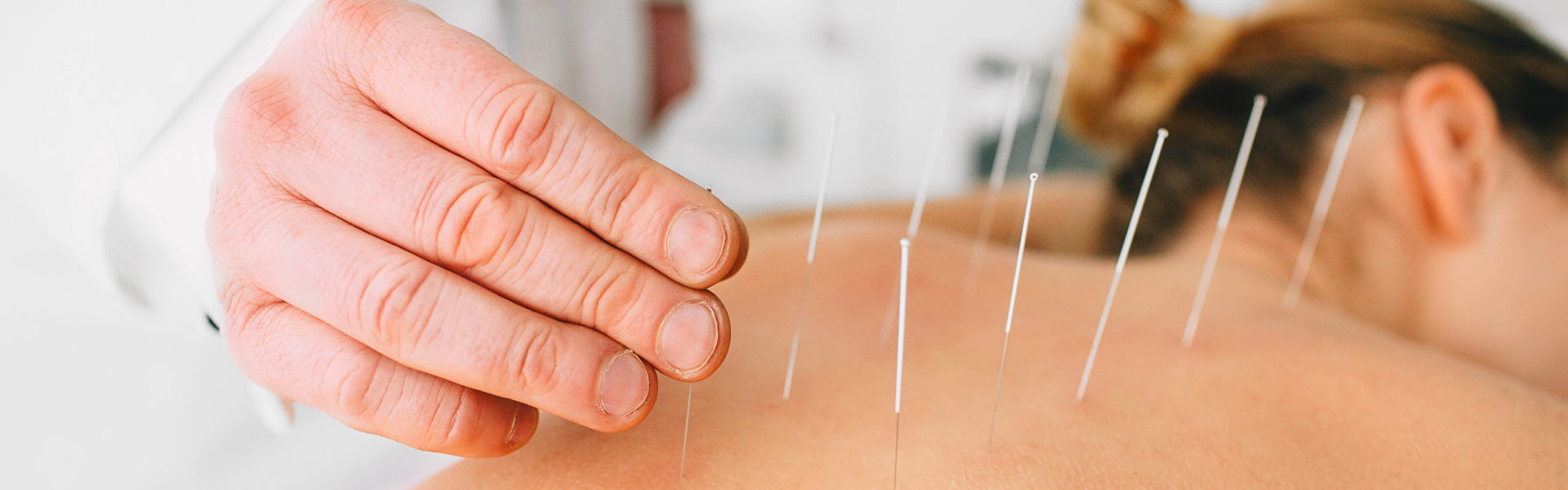 acupuncture