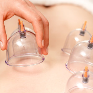 cupping therapy