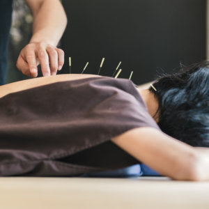 acupuncture therapy