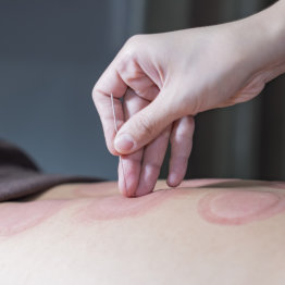 performing acupuncture after cupping therapy