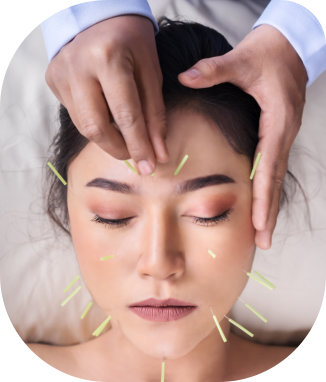 lady face treated by acupuncture