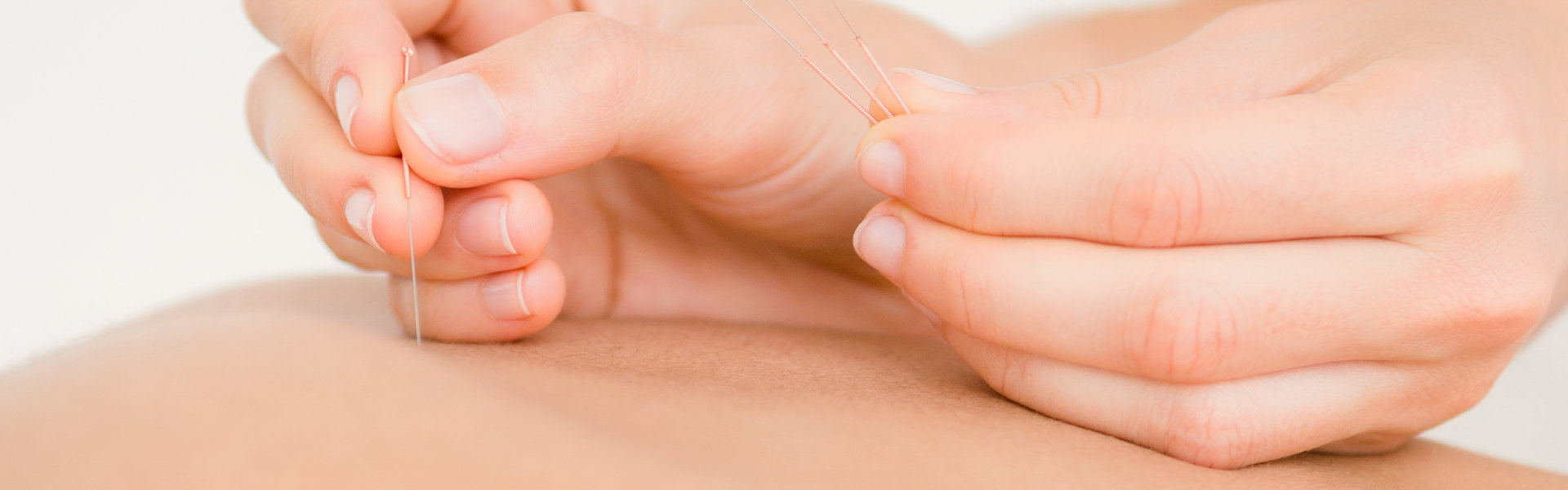 performing acupuncture